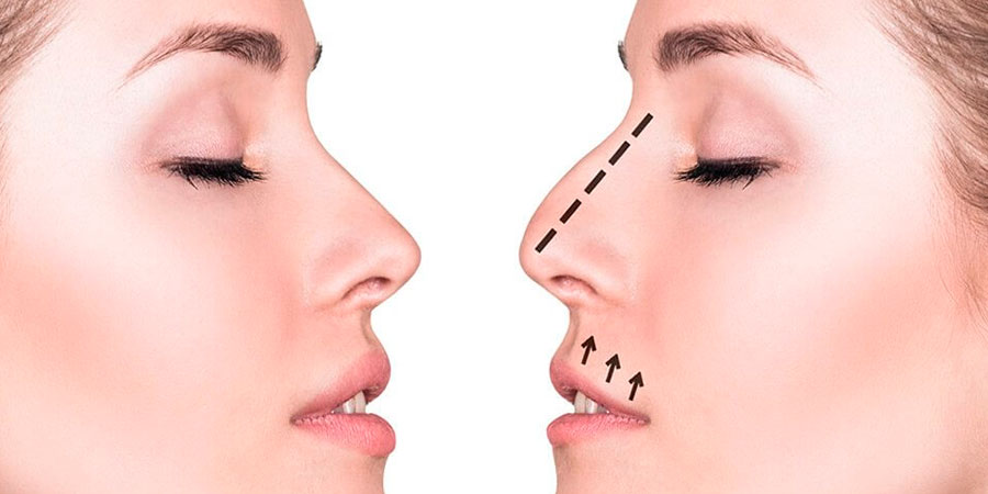Rinoplastia - Cirurgia de nariz